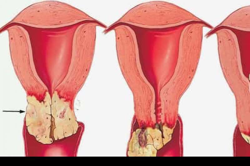 سرطان عنق الرحم