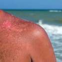 علاج حروق الجلد من أشعة الشمس في البحر