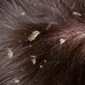 نصائح للتخلص من قشرة الشعر للنساء